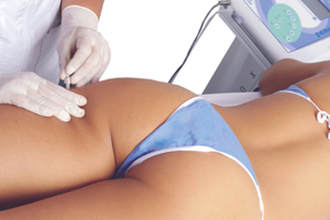 Carboxiterapia